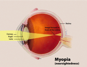 Kết quả hình ảnh cho myopia"