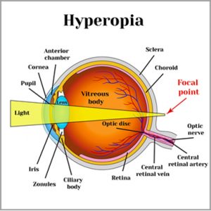 Kết quả hình ảnh cho hyperopia"